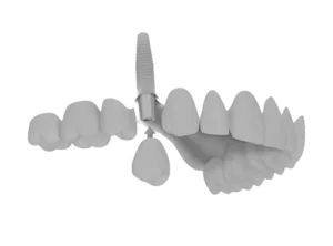 Implantes Dentales Clinica Dental Care Barcelona 300X222 1 | Jose Tapias Luque
